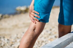 Are Varicose Vein Treatments Covered by Insurance?