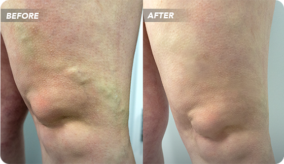 before-and-after-varicose-veins