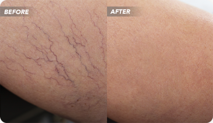 VTCBefore-After