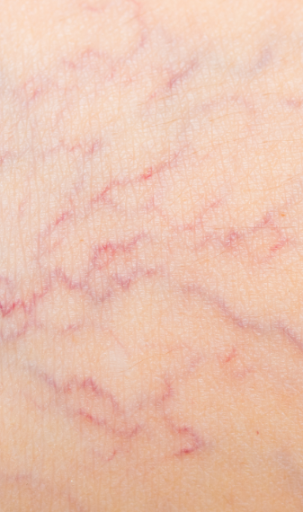 Do Spider Veins Come Back After Laser Treatment? | Vein Treatment