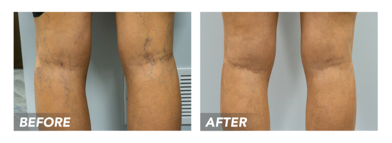 What Is Chronic Venous Insufficiency? - The Vein Center