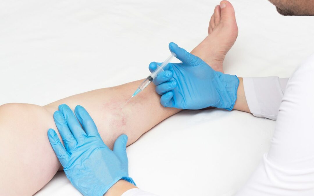 Why Do My Legs Look Worse After Sclerotherapy? And Other Spider Vein Treatment FAQs