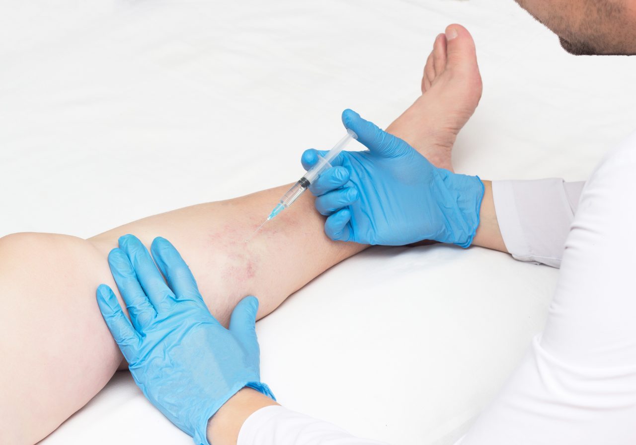 How much does it cost to get your veins stripped? What are the factors affecting the cost of varicose vein treatments? We answer your questions about vein treatment costs in California.